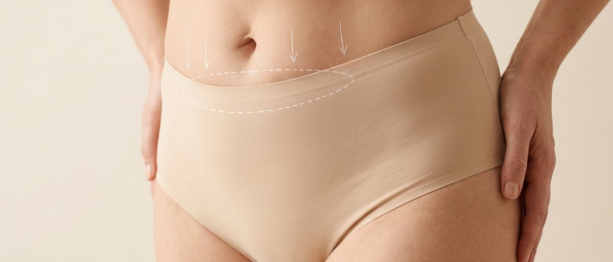 شد البطن المصغّر (Mini Tummy Tuck)